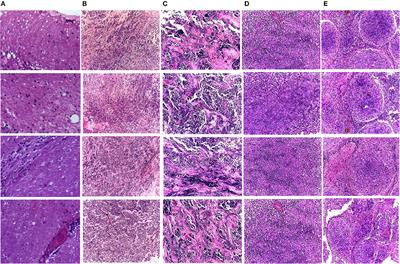 CoMB-Deep: Composite Deep Learning-Based Pipeline for Classifying Childhood Medulloblastoma and Its Classes